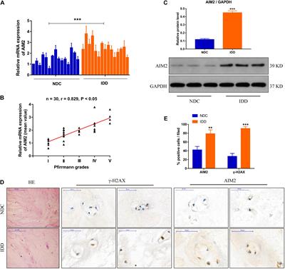 Autophagy-Based Unconventional Secretory for AIM2 Inflammasome Drives DNA Damage Resistance During Intervertebral Disc Degeneration